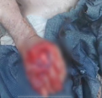 Homem sofreu ferimentos graves nas duas m&atilde;os (Foto: Reprodu&ccedil;&atilde;o/FM)